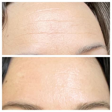 how long to see results from retinol